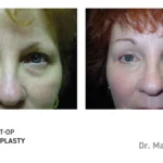 Pre&Post-Op_Blepharoplasty_01