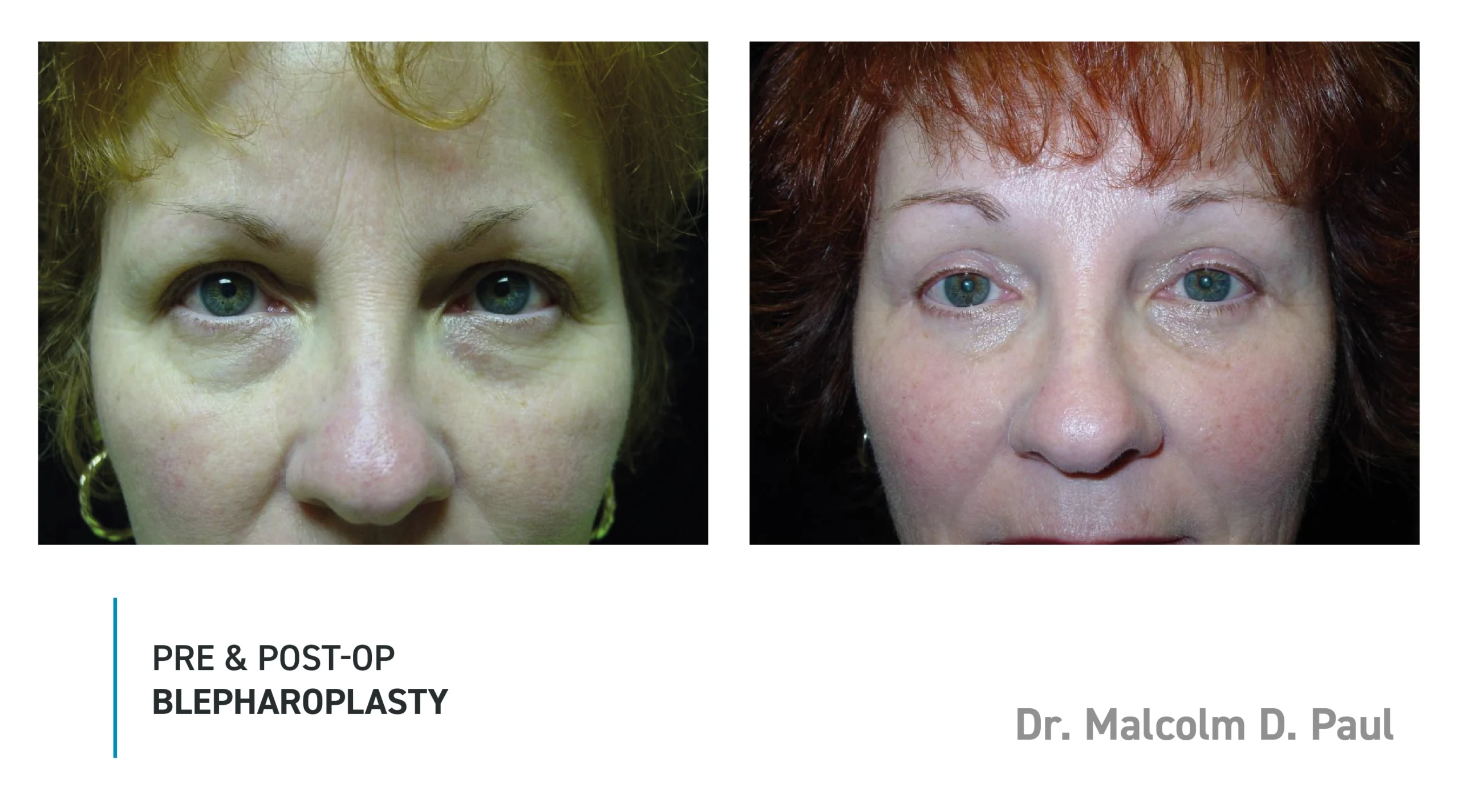 Pre&Post-Op_Blepharoplasty_01