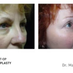 Pre&Post-Op_Blepharoplasty_02