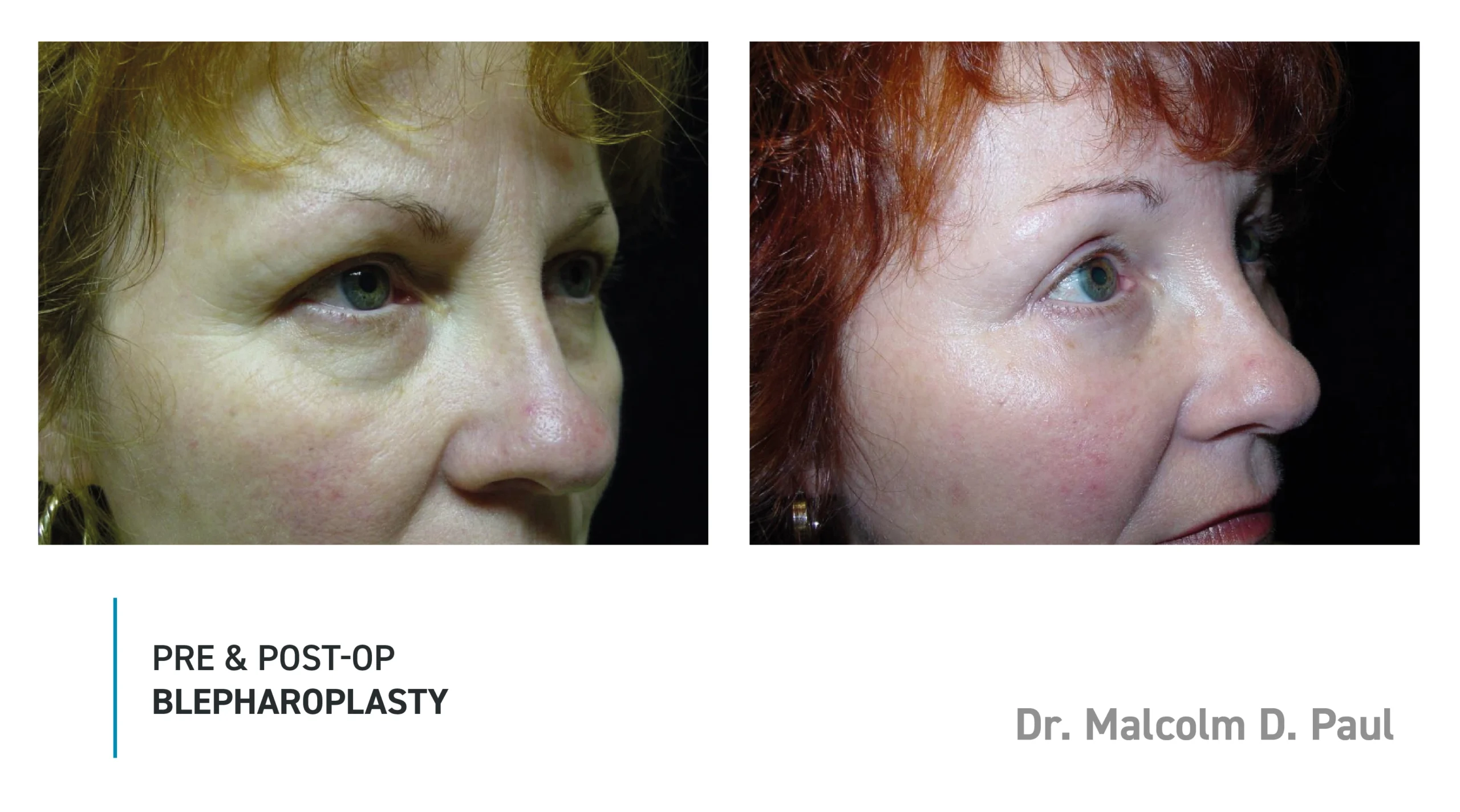 Pre&Post-Op_Blepharoplasty_02