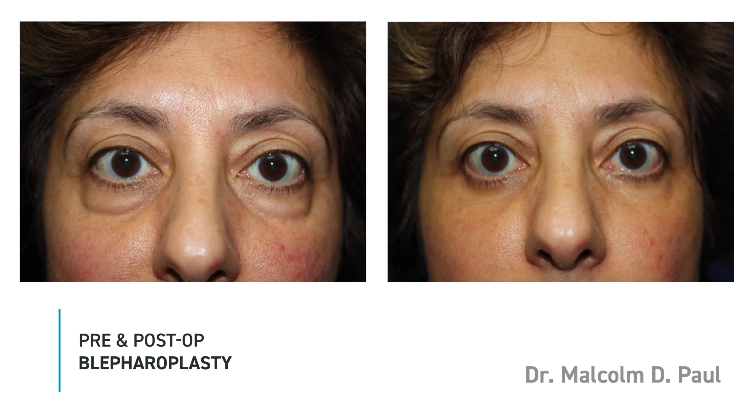 Pre&Post-Op_Blepharoplasty_03