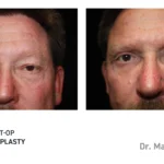 Pre&Post-Op_Blepharoplasty_04