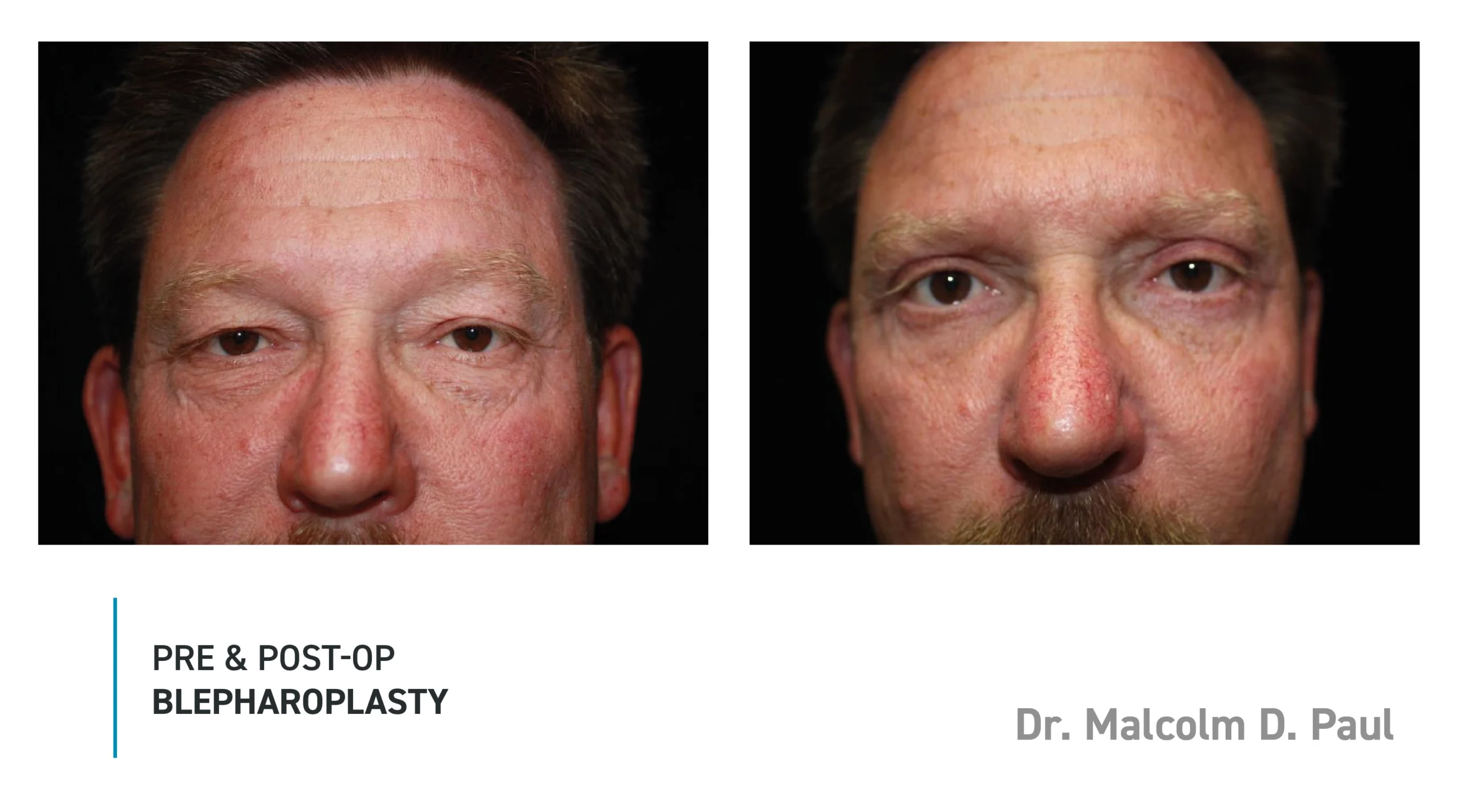 Pre&Post-Op_Blepharoplasty_04