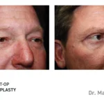 Pre&Post-Op_Blepharoplasty_05