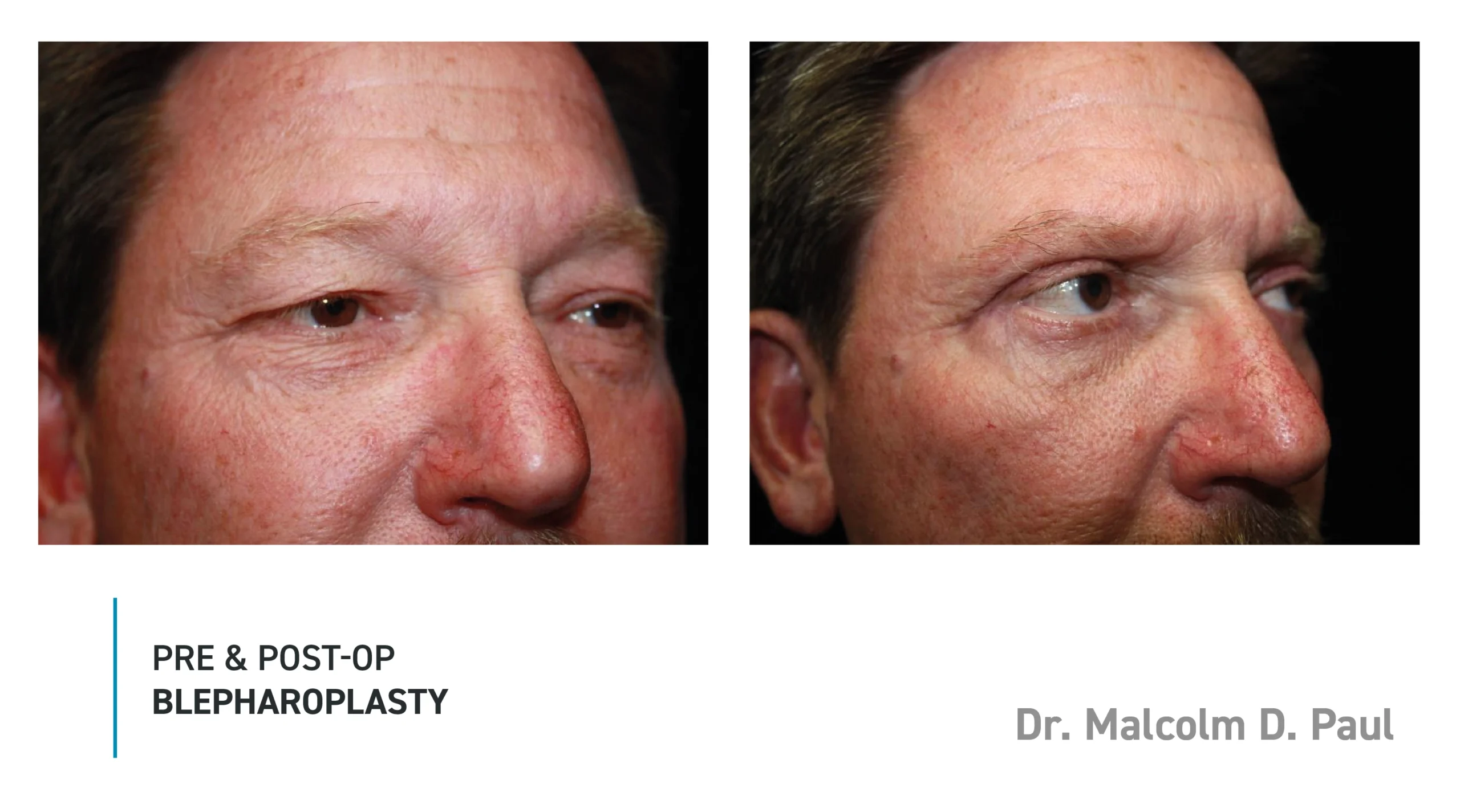 Pre&Post-Op_Blepharoplasty_05