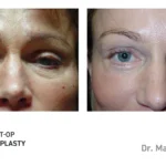 Pre&Post-Op_Blepharoplasty_06