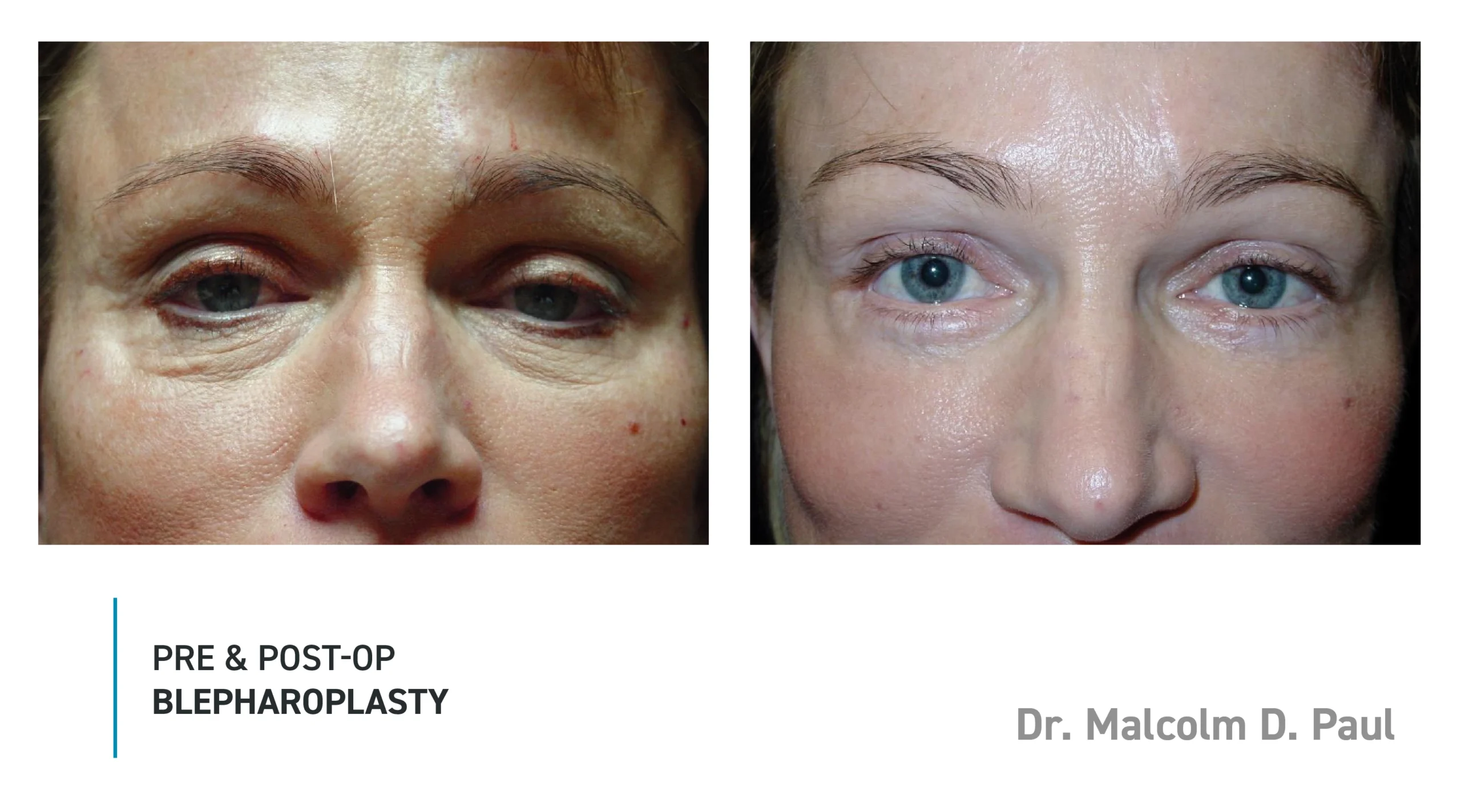 Pre&Post-Op_Blepharoplasty_06