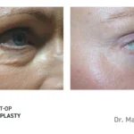 Pre&Post-Op_Blepharoplasty_07