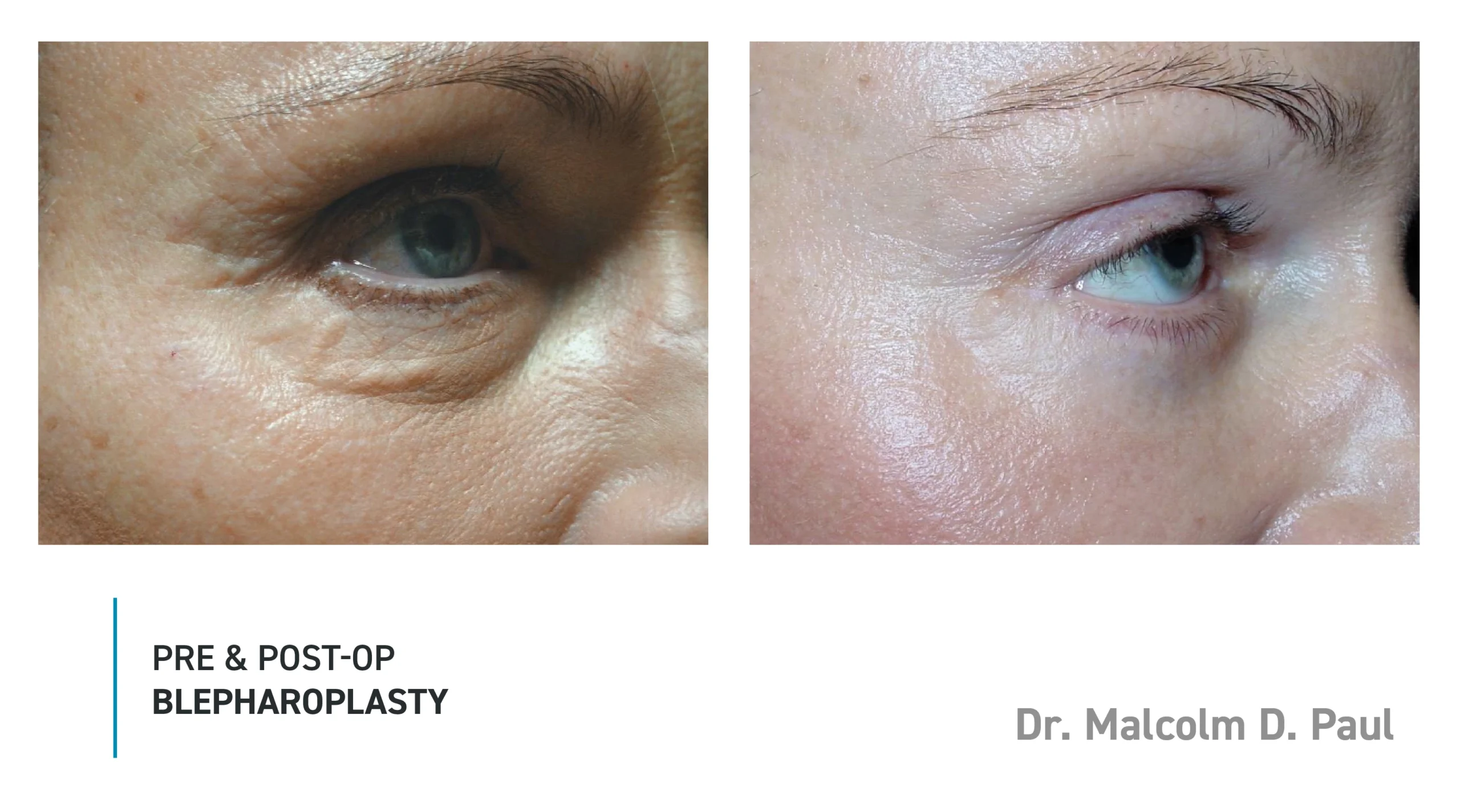 Pre&Post-Op_Blepharoplasty_07