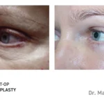 Pre&Post-Op_Blepharoplasty_08