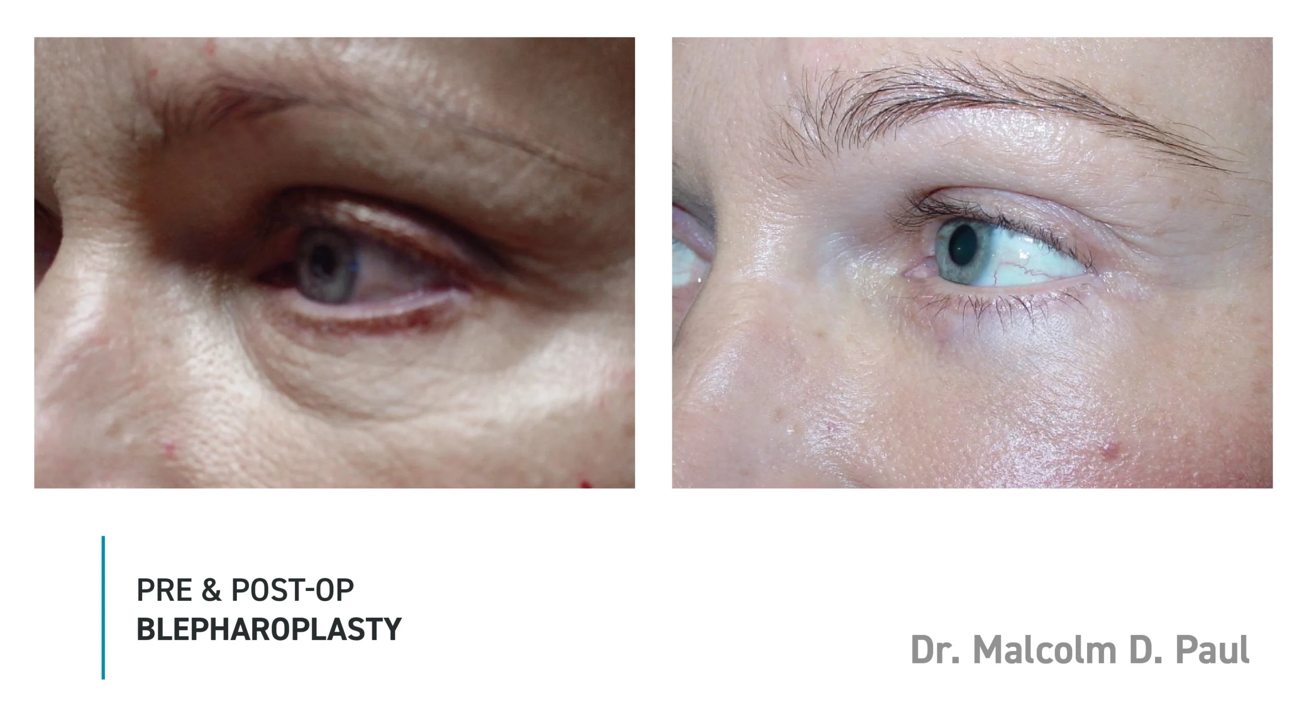 Pre&Post-Op_Blepharoplasty_08