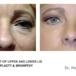 Pre&Post-Op_Blepharoplasty_09