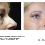 Pre&Post-Op_Blepharoplasty_10