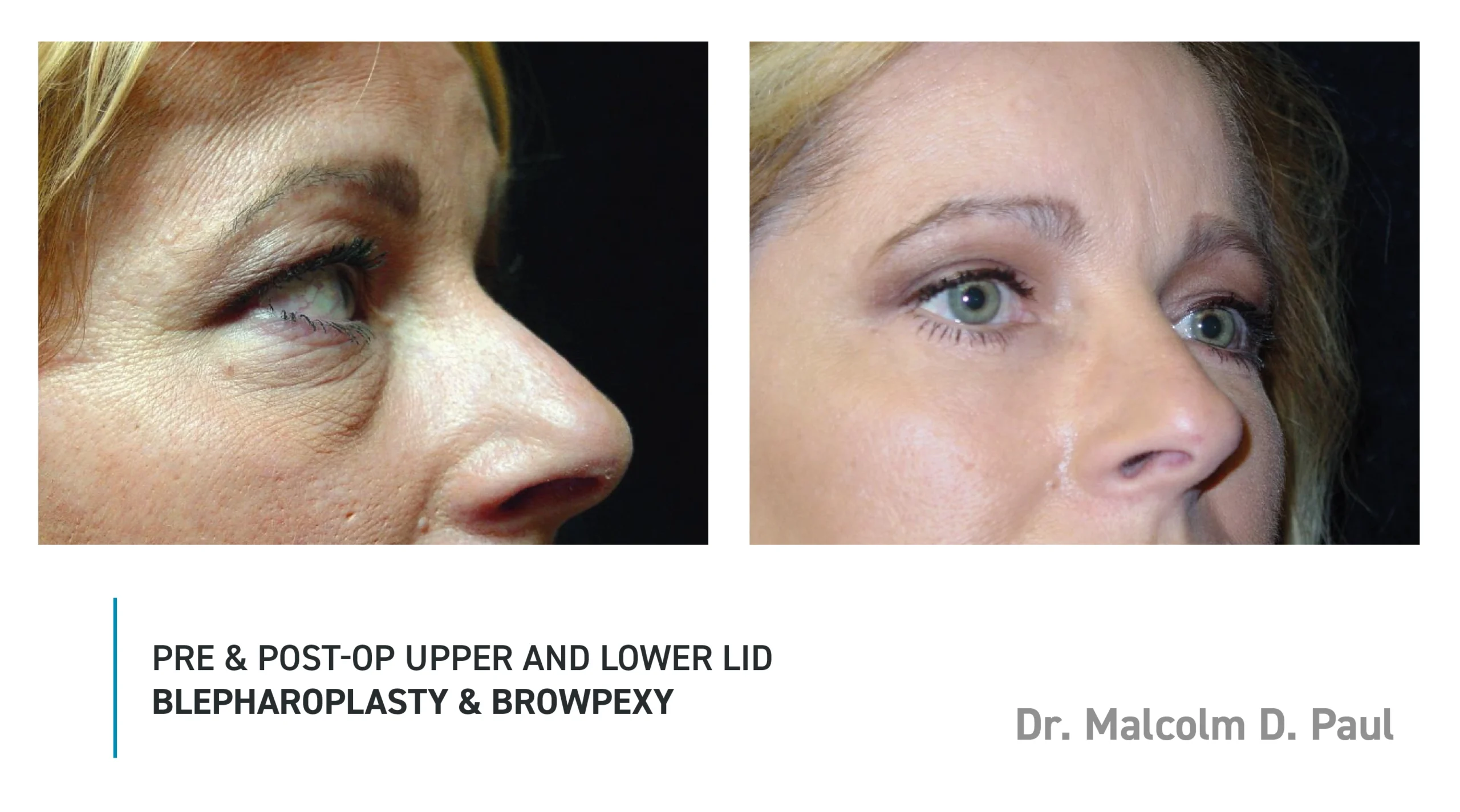 Pre&Post-Op_Blepharoplasty_10
