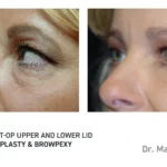 Pre&Post-Op_Blepharoplasty_11