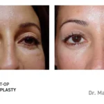 Pre&Post-Op_Blepharoplasty_12