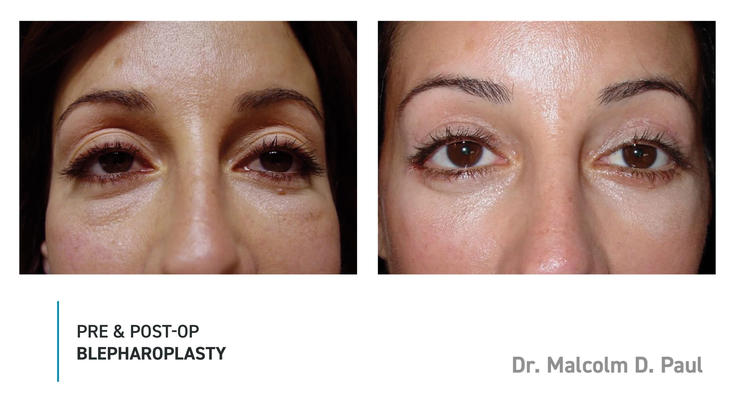 Pre&Post-Op_Blepharoplasty_12