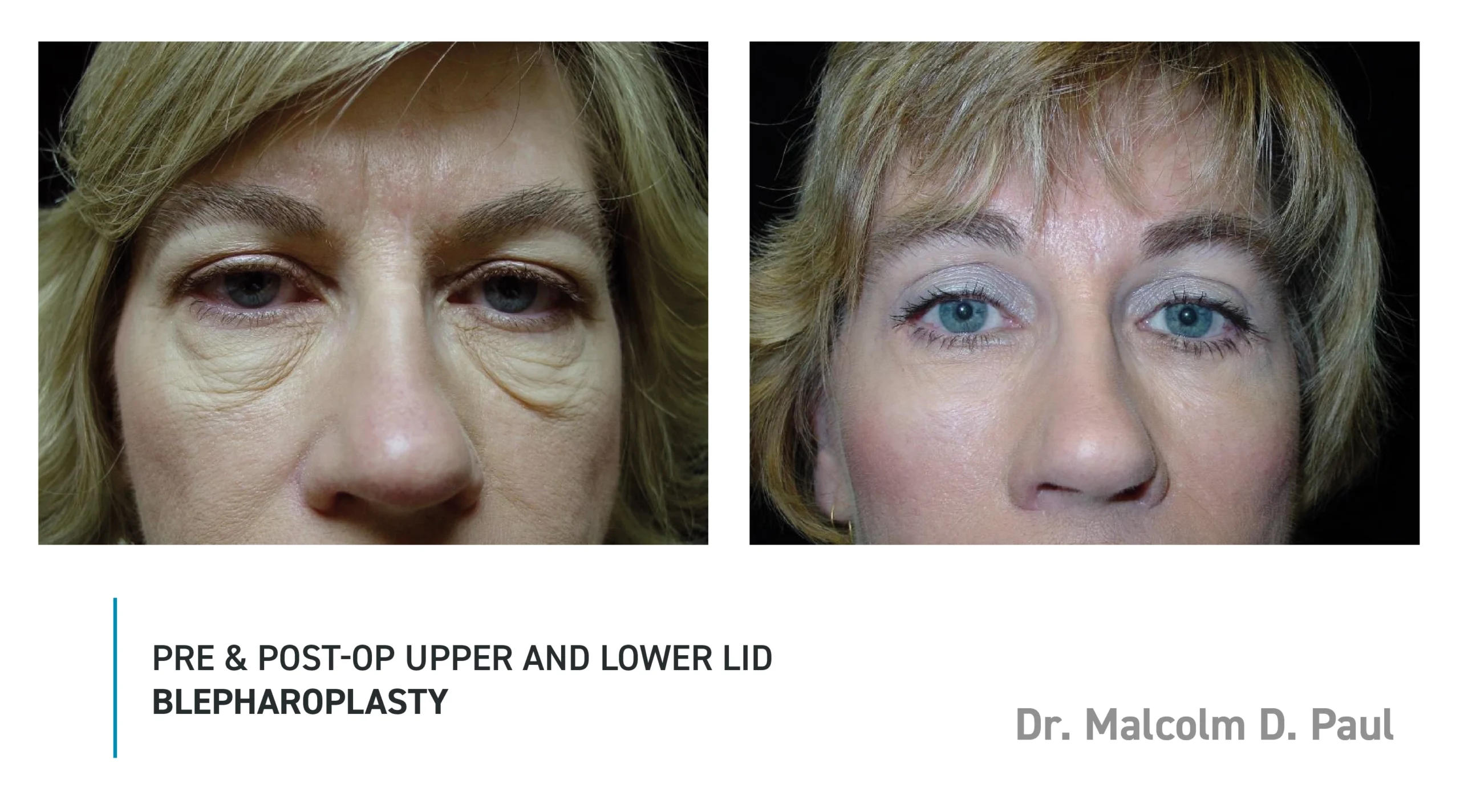 Pre&Post-Op_Blepharoplasty_13