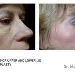 Pre&Post-Op_Blepharoplasty_14