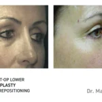 Pre&Post-Op_Blepharoplasty_15