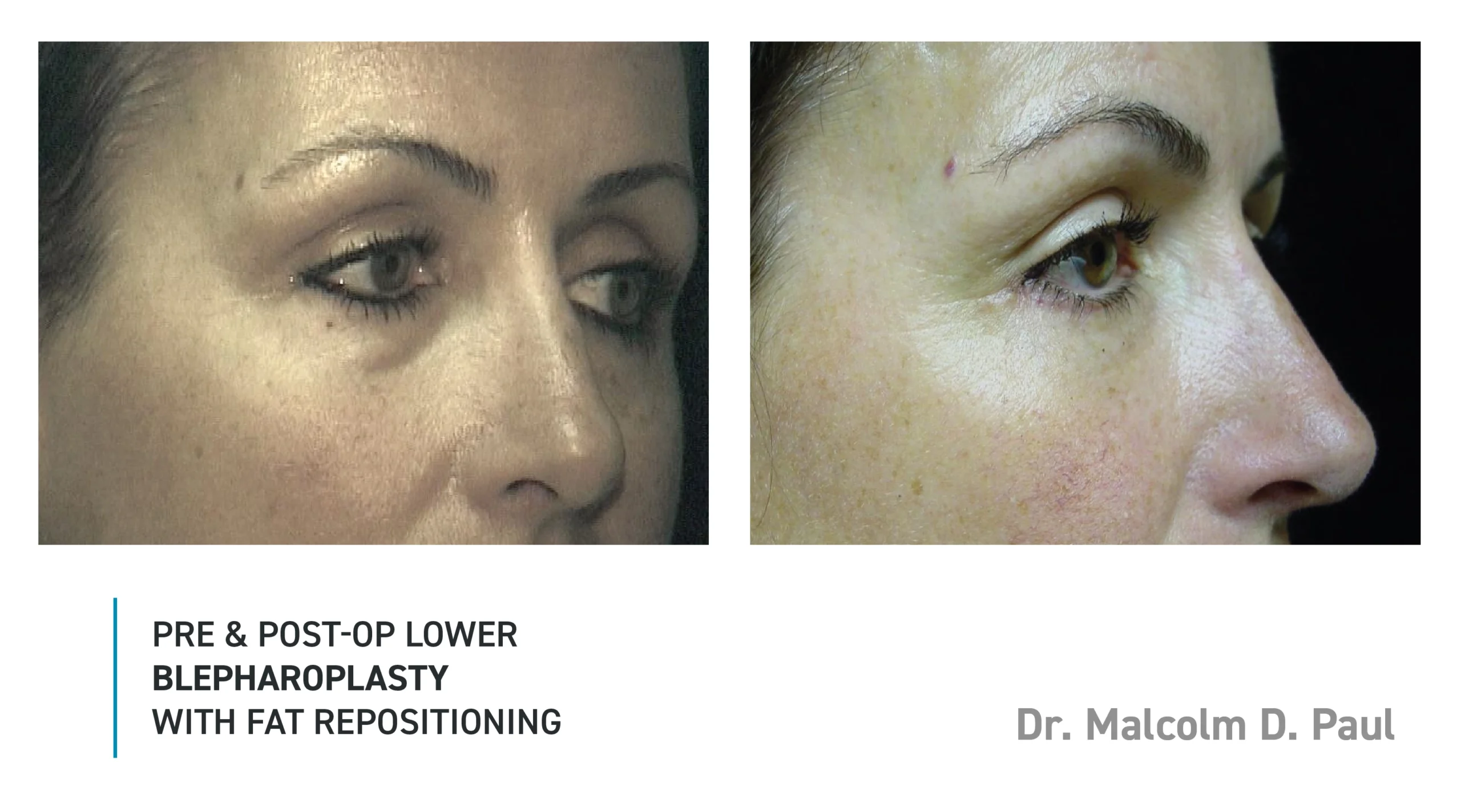 Pre&Post-Op_Blepharoplasty_15