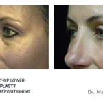 Pre&Post-Op_Blepharoplasty_16