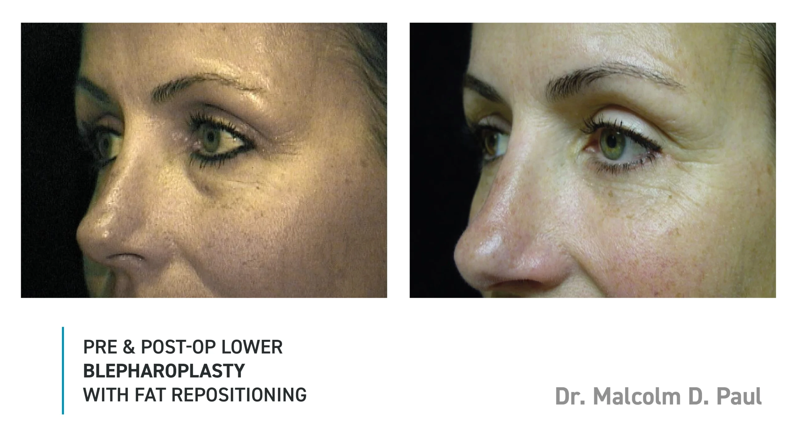 Pre&Post-Op_Blepharoplasty_16