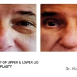 Pre&Post-Op_Blepharoplasty_17