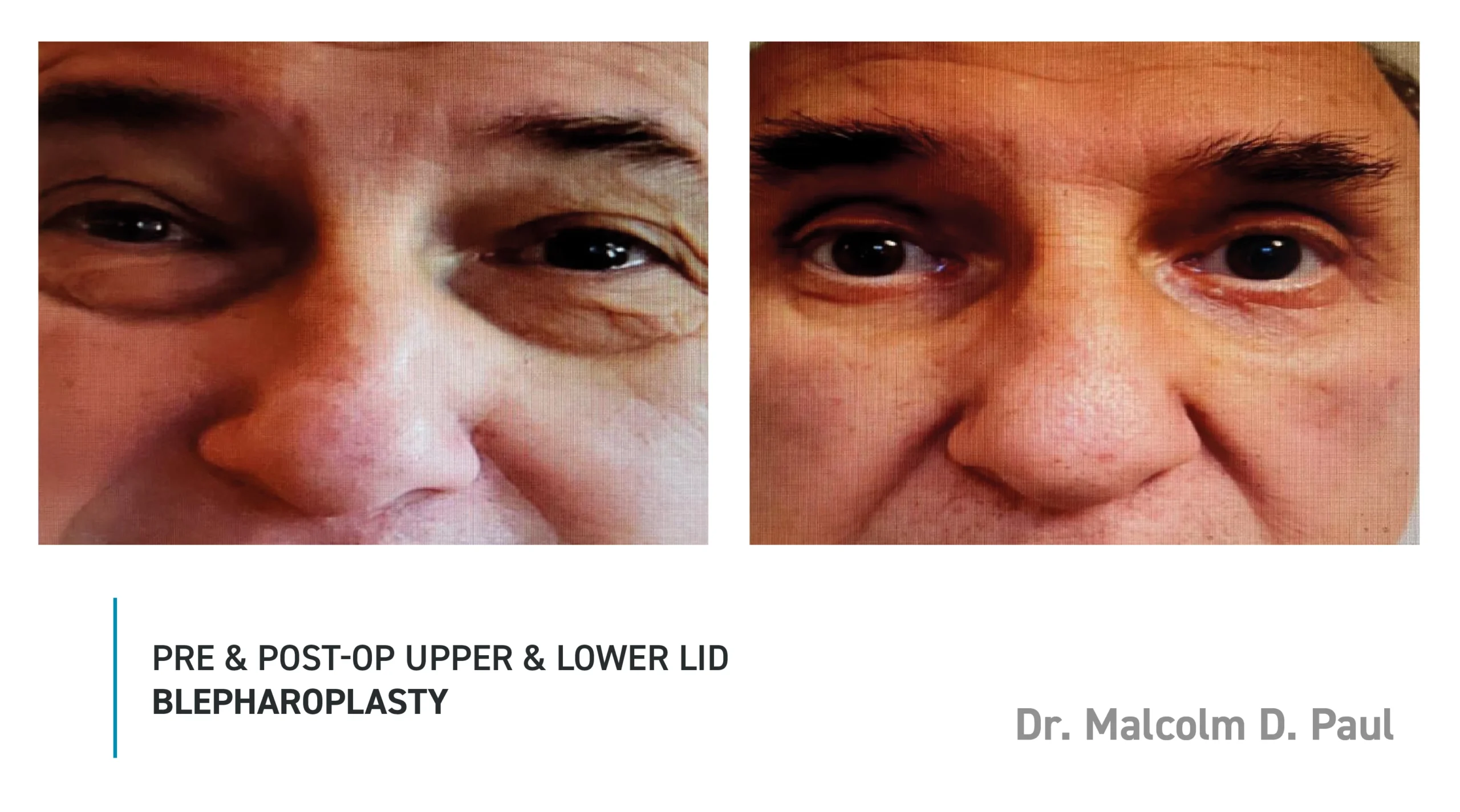 Pre&Post-Op_Blepharoplasty_17